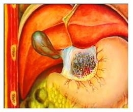 人体胆结石疾病如何分类