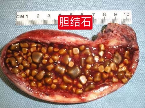 新区中医医院脾胃病科"ercp"治疗胆道蛔虫症胆结石,镜下微创恢复快