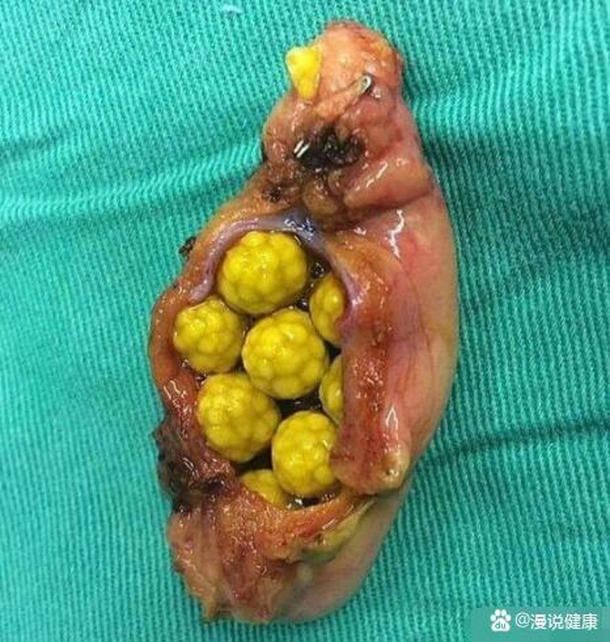 胆固醇胆结石 ,像什么?