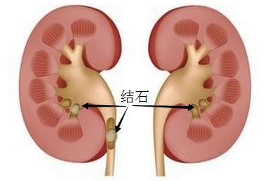 泌尿系结石,这种疼痛极少有人能够忍受