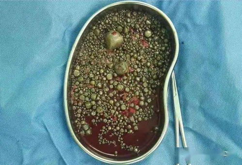 莫让结石伴胆行