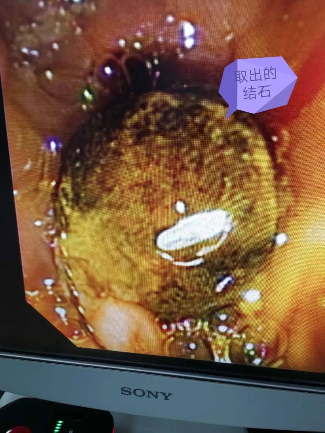 治胆结石可首选经脐无痕保胆取石_网易订阅