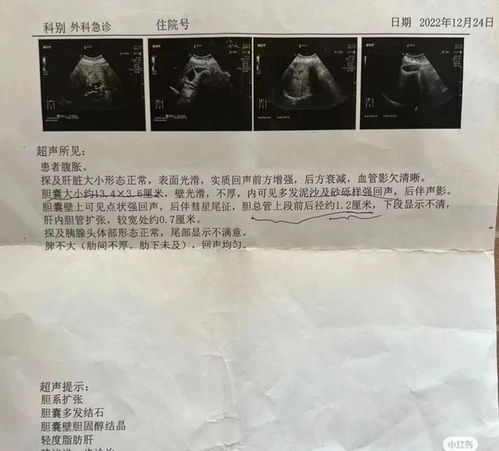 胆结石 胆囊炎,不用怕 咱老百姓有验方和食疗方