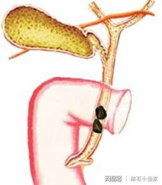 手术治疗胆结石之后就万事大吉了吗 不注意这几点后果很严重