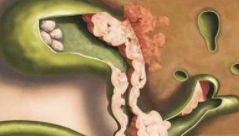 胆结石吃什么药