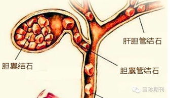 胆囊炎和胆结石 国珍营养套餐调理方案