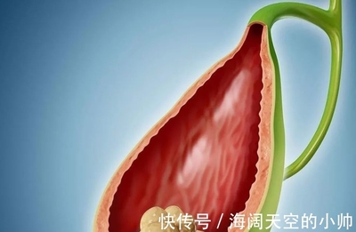 胆囊炎是不是一定并发胆结石呢?