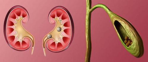 得了胆结石,是否还能保住胆囊