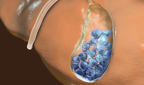 胆结石的 元凶 是什么 这6个因素都可能产生结石,早点避开