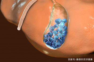 患胆结石后,6种食物要避开,不要自找麻烦