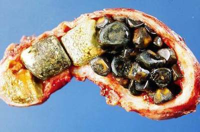 胆结石的营养疗法,根治之法!