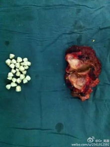 胆结石原来是这样 胆小慎入