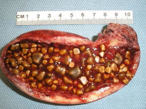 生活方式 习惯也是促进胆结石发生的重要原因