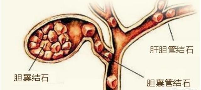 急性胆结石发作与治疗指南