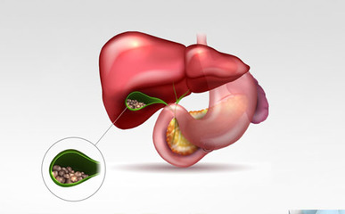 胆结石的三大误区