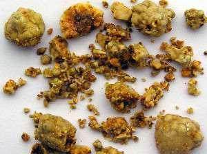 胆结石并非一概需取胆 科学认知与个体化治疗策略