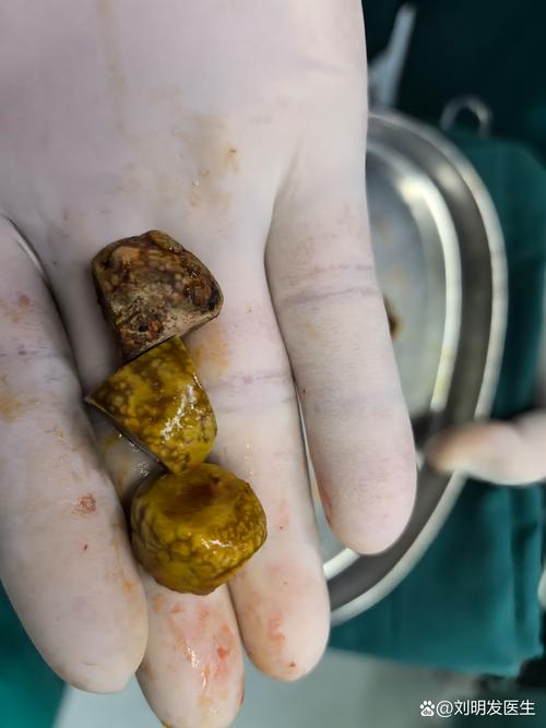 胆囊结石的长期病程及其健康影响