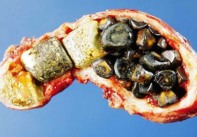 90%胆结石患者不吃早饭？饮食规律与胆结石的密切关系