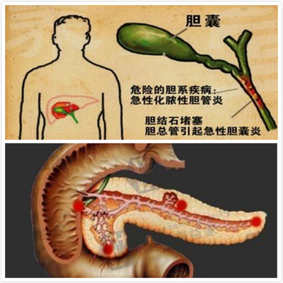 过山车能否排出胆结石？科学解析与医学建议