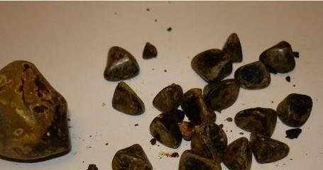 轻松排出体内结石 肾结石与胆结石的自然缓解法