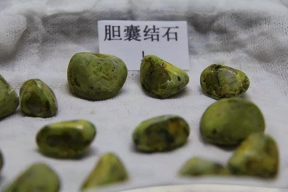 胆结石治疗方式的演进 从保胆取石到胆囊切除的医学深思