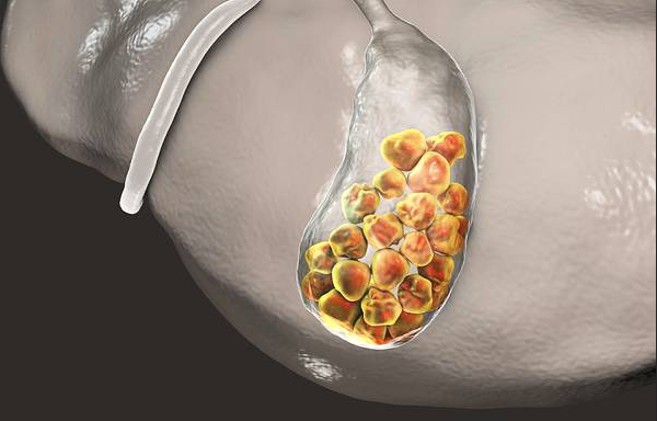 胆结石会诱发胰腺炎吗？告知你胆结石的几个真相