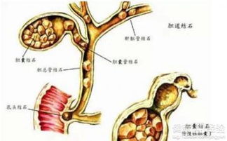 胆结石中药排石 为何剧烈疼痛？科学防治有策略