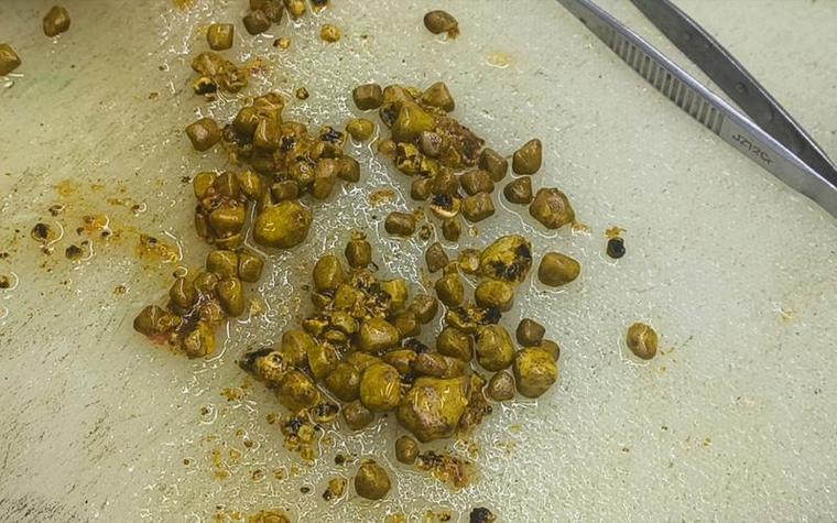 坚持一年半,胆结石奇迹消失!