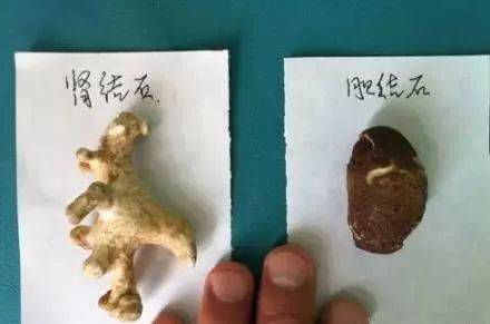 肝胆外科大侠们的手拍图,用真实的图片告诉你胆结石的真相