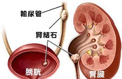 肾结石 尿结石 胃结石 疼死人的结石都该如何预防